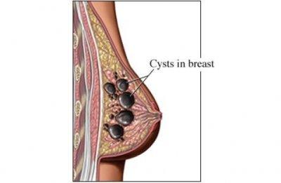 Breast Cysts