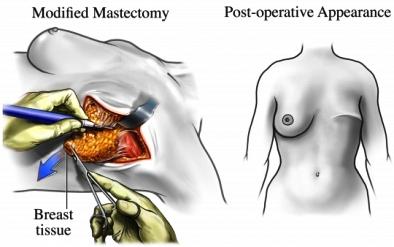 Mastectomy