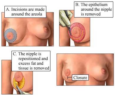 Breast Reduction Procedure