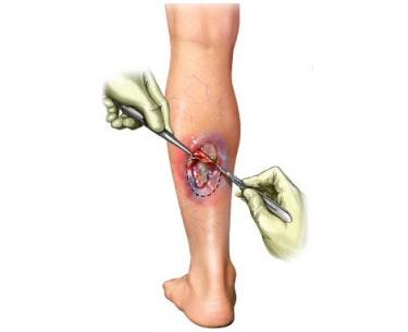 Surgical Debridement of Lower Leg Wound