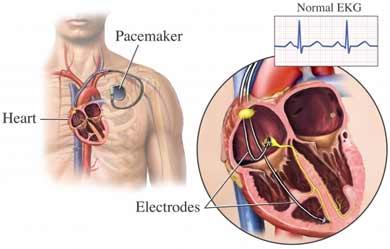 Pacemaker Insertion