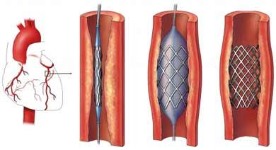 Coronary Artery: Stent Procedure