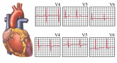 ECGs Revealing Cardiac Muscle Damage