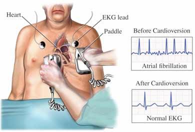 External Cardioversion