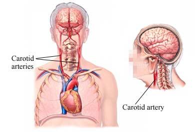 Carotid Artery