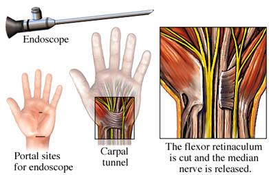 Endoscopic Release of Carpal Tunnel