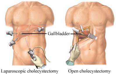 Laparoscopic Cholecystectomy vs. Open Cholecystectomy