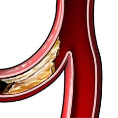 Plaque Formation in Blood Vessel—Side Effect of High HDL Cholesterol