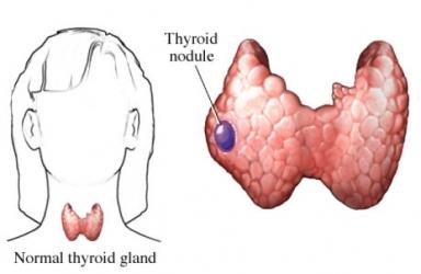 Thyroid Nodule