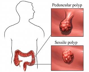 Colon Polyps