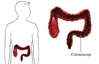 Colonoscopy