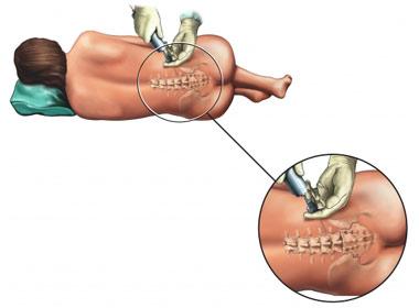 Epidural Injection