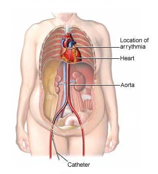 Pathway of Catheter Toward the Heart