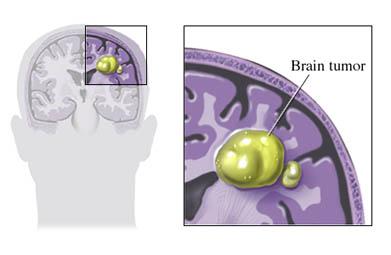 Brain Tumor