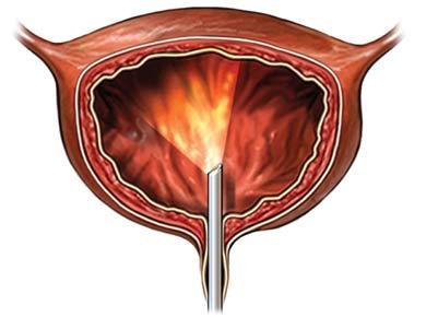 Cystoscopy of the Bladder