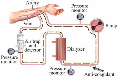 Hemodialysis