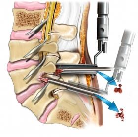 Laparoscopic Removal of Disc Tissue