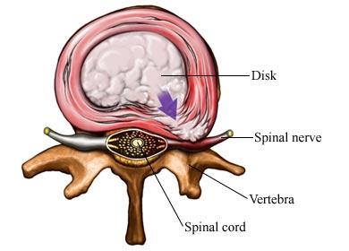 Lumbar Disc Herniation With Pinching of Spinal Nerve