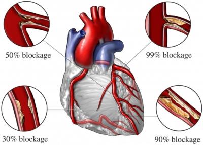 Varying Degrees of Atherosclerosis in Coronary Arteries