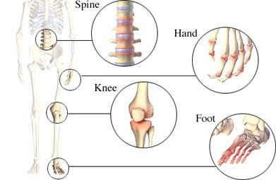 Joints Affected by Osteoarthritis
