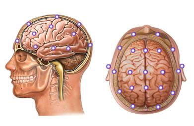 Placement of Sensors for an EEG