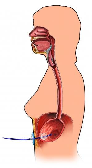 Gastric Tube