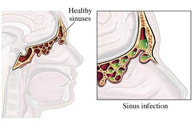 Sinus Infection