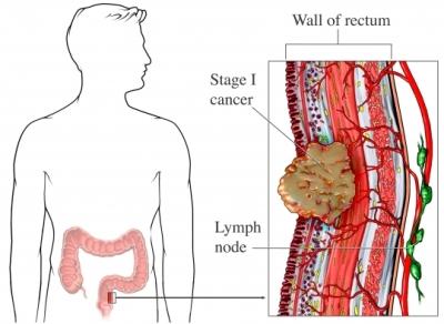 Colorectal Cancer