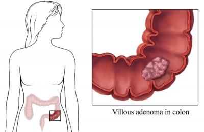 Adenomatous Polyp in Colon