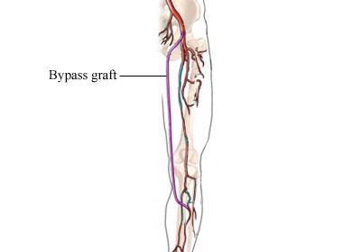 Femoropopliteal Bypass Graft