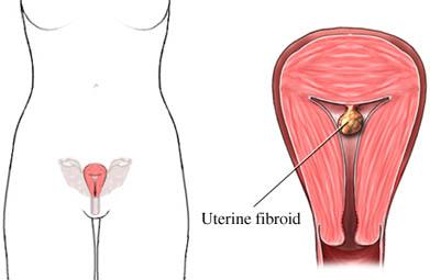 Uterine Fibroid