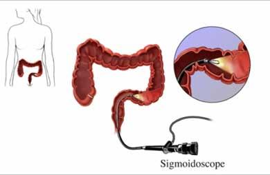 Sigmoidoscopy