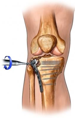 Open Reduction of Tibia