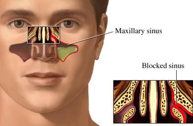 Blockage of Sinuses