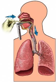 Endotracheal Intubation