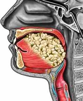 Cancer of the Tongue