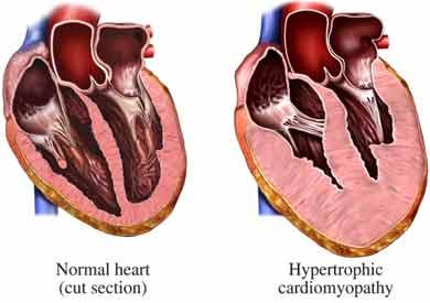 Normal vs. Diseased Heart