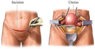 Abdominal Hysterectomy