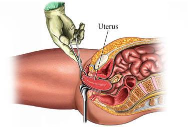 Vaginal Hysterectomy