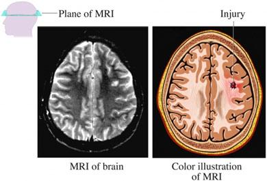 MRI of Brain Injury