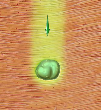 External Radiation of a Tumor