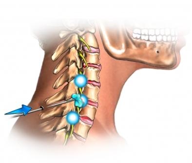 Cervical Injection