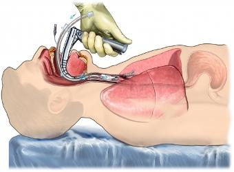 Endotracheal Intubation