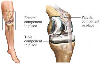 Total Knee Replacement