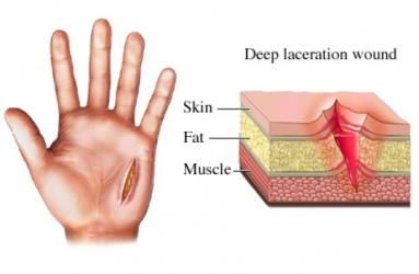 Laceration Wound of the Hand
