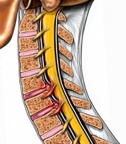 Ruptured Disc in Neck Pushing on Nerves