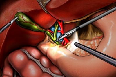 Laparoscopic Cholecystectomy