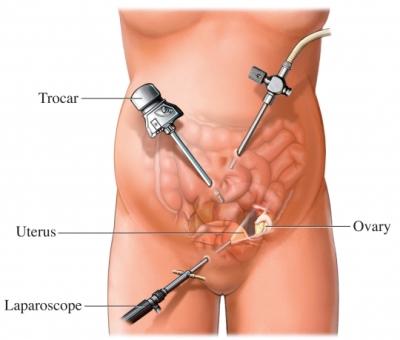 Laparoscopic Tools