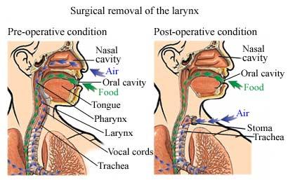 Laryngectomy