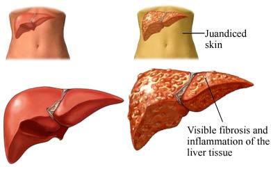 Normal vs. Diseased Liver